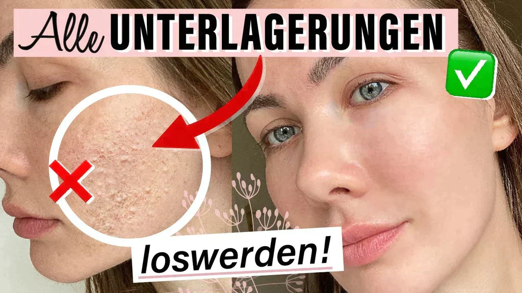 Unterlagerungen im Gesicht: Kinn & Stirn loswerden