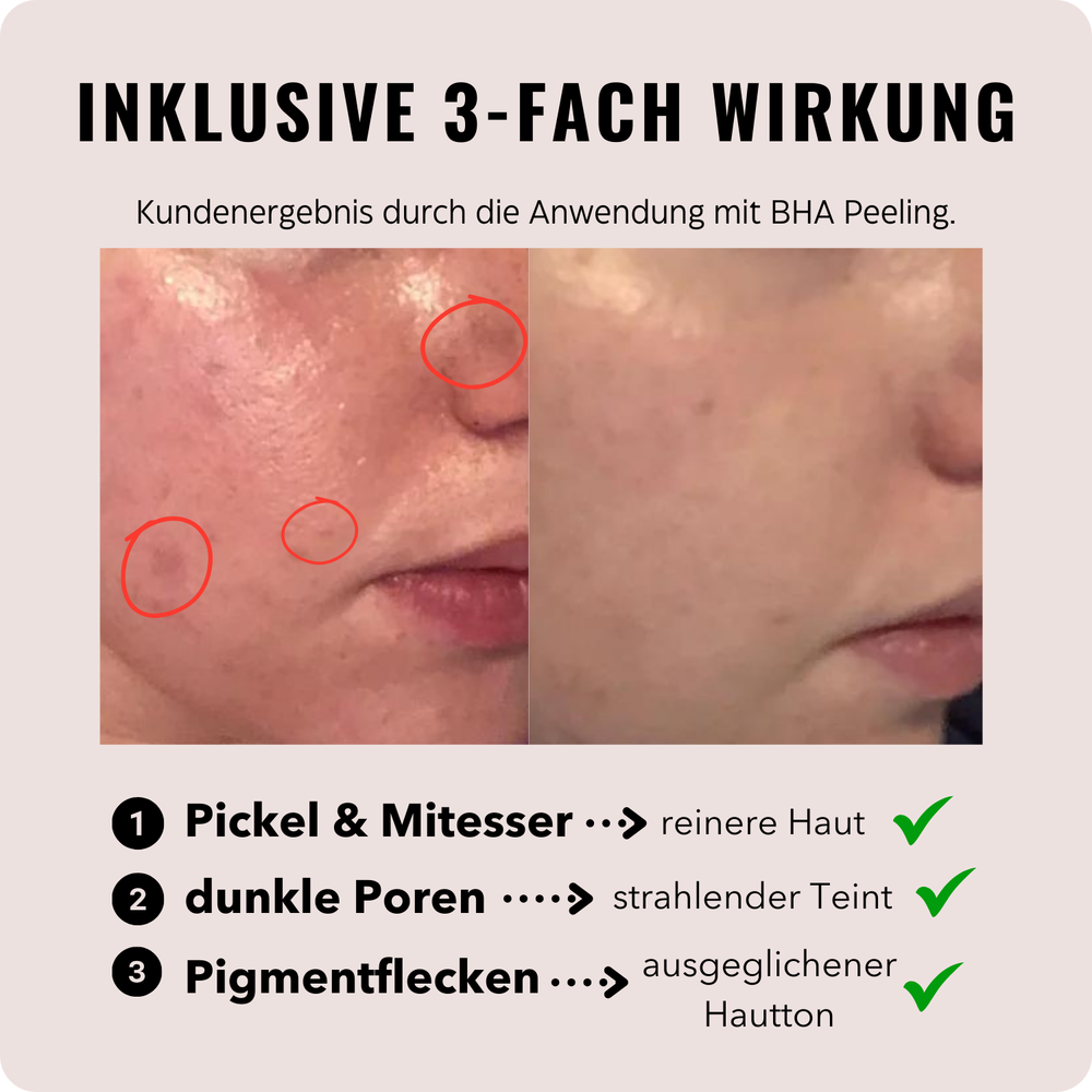 
                      
                        Porenfeines 4% BHA PEELING
                      
                    